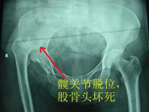 骨痹，右股骨頭壞死中醫(yī)醫(yī)案